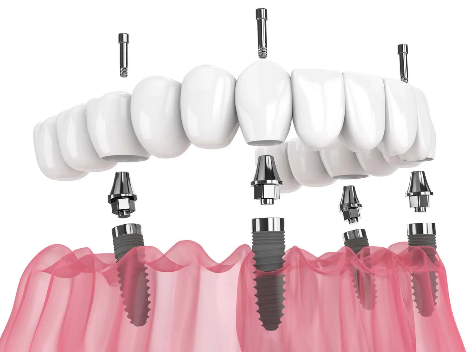 Full arch dental implant restoration replacing an entire set of teeth